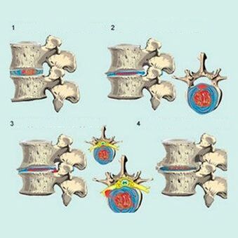 stage of development of cervical osteochondrosis