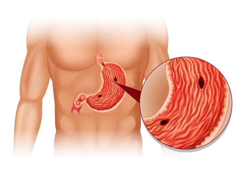 ulcer as a cause of pain under the left scapula in the back