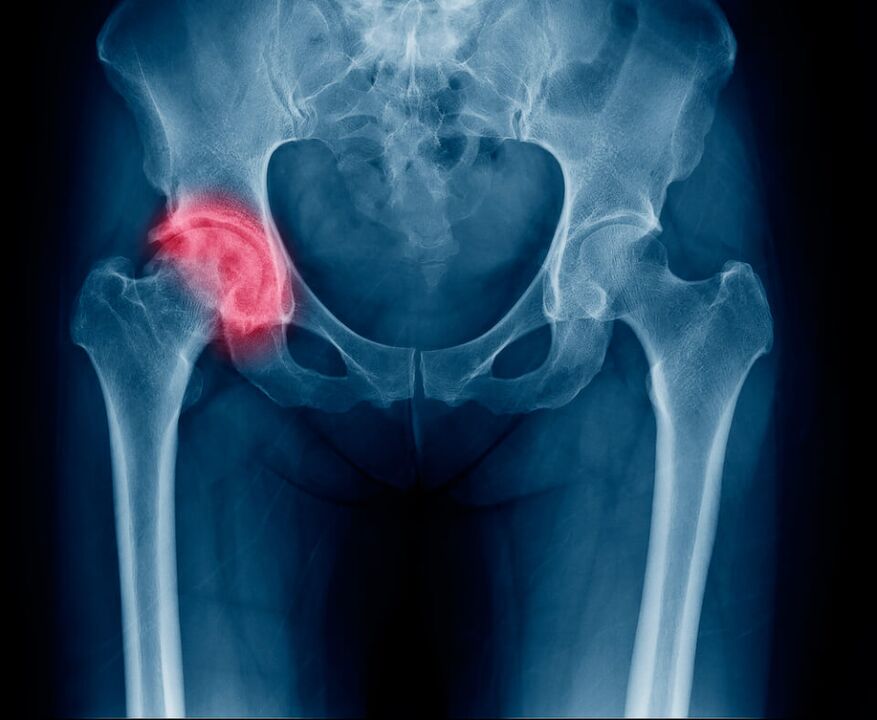 Fracture of the femoral neck, causing pain to radiate to the leg