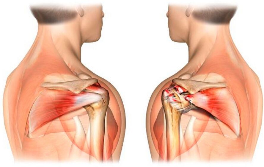 A healthy shoulder with arthrosis