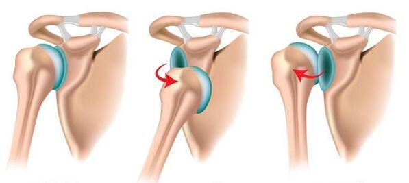 Anterior and posterior dislocation of the shoulder joint, provoking the development of arthrosis