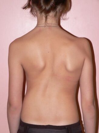 Scoliosis 2 degrees