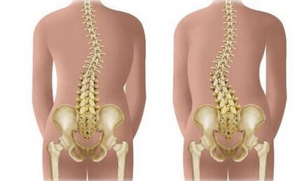 Scoliosis is not a presistant