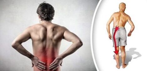 Pain syndrome with lumbar osteochondrosis emits legs