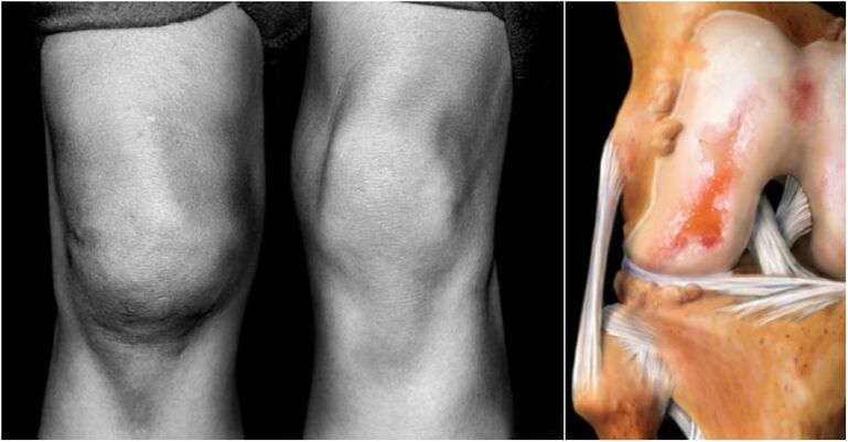 Arthrosis of the knee joint and joint pain