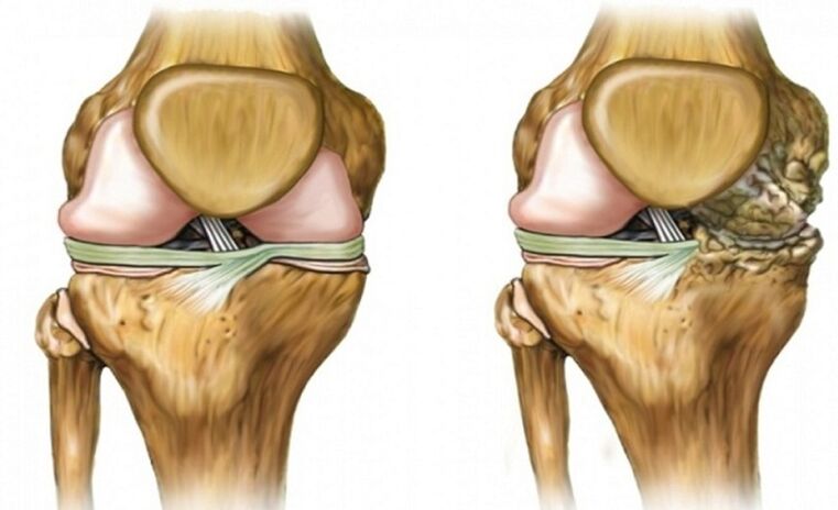 Healthy and affected by arthrosis joints