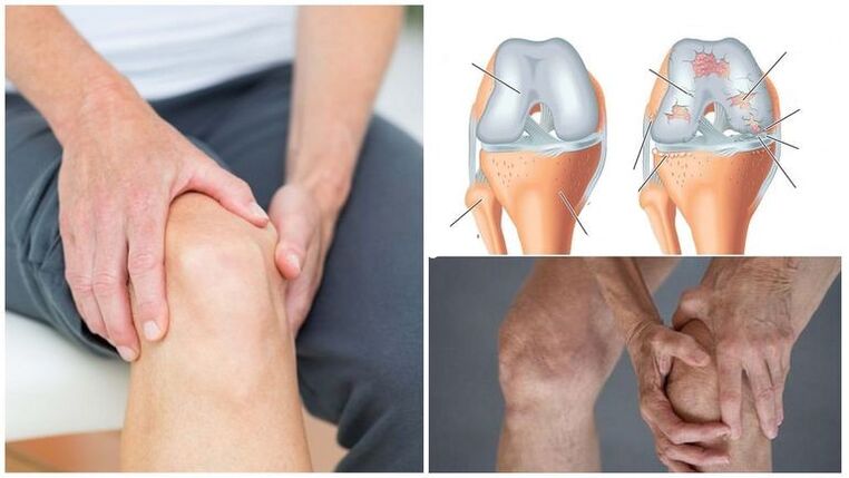 Symptoms of knee arthrosis of the knee joint