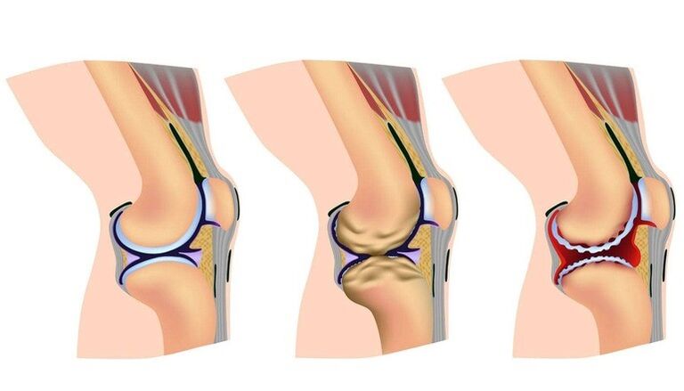 The level of deformation on the knee joint for arthrosis