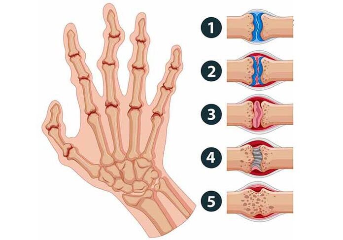 stage of development of finger joint arthritis