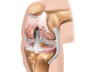 the layout of the arthritis